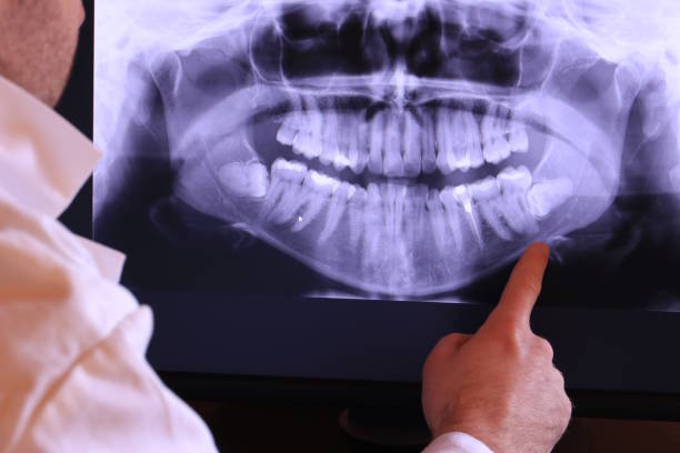Best Emergency Dentist for Lost Fillings or Crowns in Summerset, SD